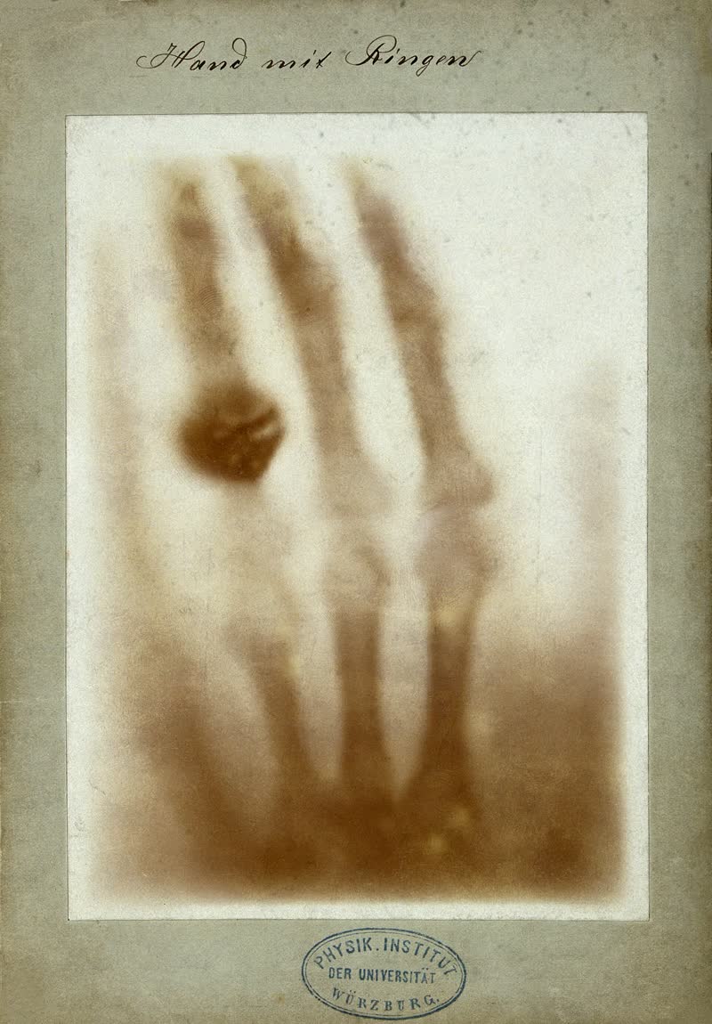 La radiografía de la mano de Anna Bertha Röntgen, de 1895.